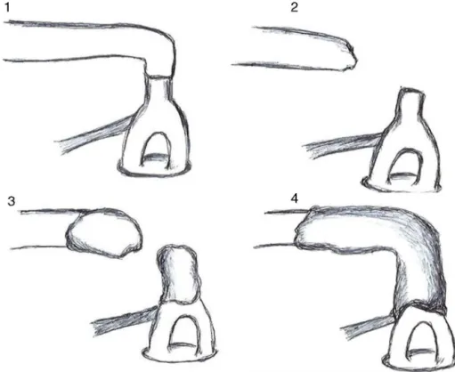 Figura 1 Desenho esquemático dos quatro tempos da reconstruc¸ão da cadeia ossicular com cimento resinoso.