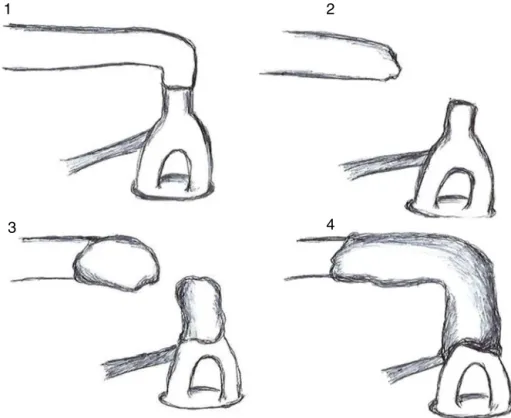 Figure 1 Schematic drawing of the four attempts at ossicular chain reconstruction with resin cement.