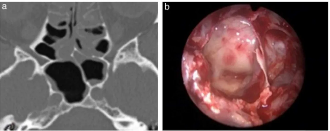 Figure 1 (a) CT scan axial view of an intersphenoid septation in the left internal carotid artery protuberance (ICAp) and (b) intraoperative view (0 ◦ endoscope) showing the same septation in the left ICAp.