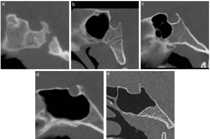 Figure 3 Sinus classification. Midsagittal reformatted images obtained from CT scans. (a---e) Types 1 through 5 sphenoid sinuses, respectively.