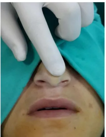 Figure 1 Recoil maneuver.