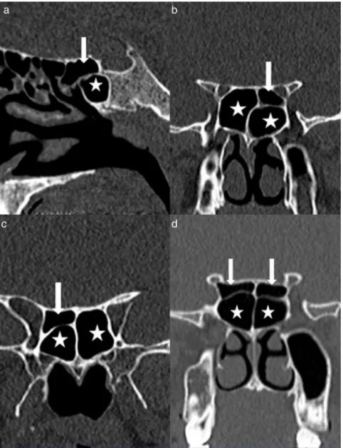 Figure 1 A coronal CT scan of the paranasal sinuses shows (a) sagittal image an Onodi cell; (b) coronal image of a left Onodi cell;