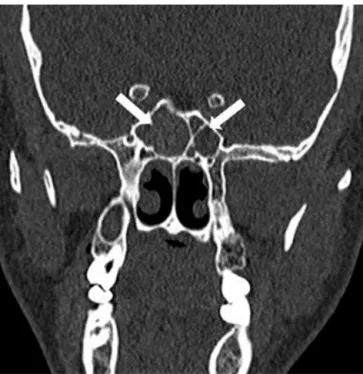 Figure 2 The CT scans of the paranasal sinuses shows bilateral sphenoiditis (arrows).