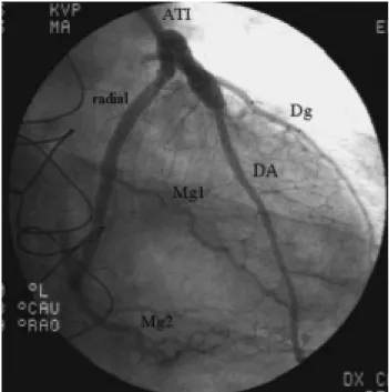 Fig. 5 – Total revascularization of the left coronary artery with a composite graft.