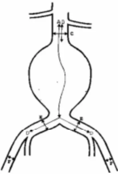 Fig. 1 - Diagram showing the basic necessary measurements to plan the implantation of a vascular endoprosthesis