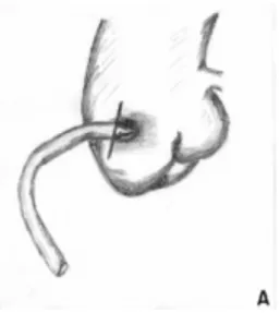 Fig. 1A - Section of coronary artery and closing of the ostium.