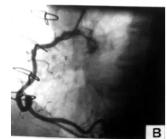 Fig. 2B - Post-operative coronary angiography
