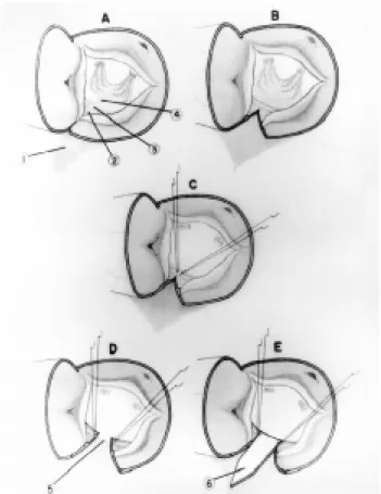 Fig. 1 - Surgical technique.  1) Left atrial roof.  2) Inter-valvular trigone.  3) Mitral annulus
