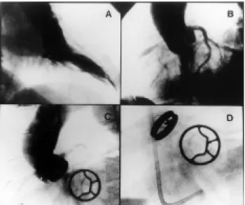 Fig. 3 - A) Pre-operative ventriculography demonstrating mitral insufficiency.  B) Pre-operative aortogram demonstrating a small annulus