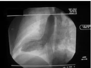 Fig. 5 - Final surgical result after coronary anastomosis. Note the dextrocardia.