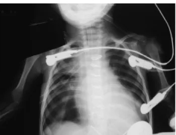 Fig. 4A and 4B – Pre-operative 2-dimensional color echocardiogram showing moderate mitral insufficiency and an significant increase in the left heart chambers.