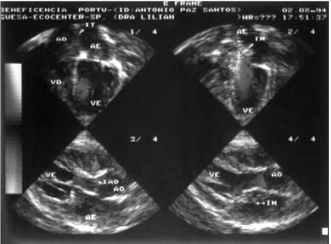 Fig. 6 - 2-dimensional color echocardiogram, demonstrating moderate mitral insufficiency and subaortic interventricular communication.