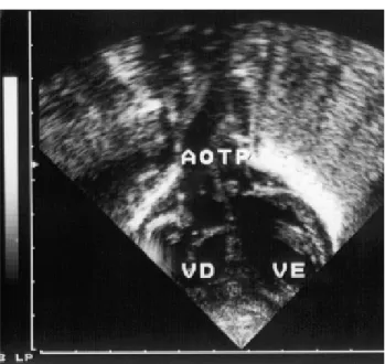 Fig. 4 – Post-operative echocardiogram demonstrating the absence of a left ventricle outflow tract obstruction