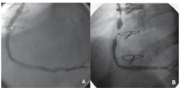 Fig. 6 – Post-operative angiographic study of a patient submitted to an anastomosis saphenous graft to the diagonal branch utilizing a mechanical suture