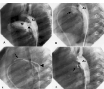 Fig. 5 -  A) Aortogram showing type-A arterial duct (arrow). B) Judkin catheter used for the anterograde approach of the right coronary artery and a second aortogram showing a significant reduction in the flow of contrast by the arterial duct (arrow)