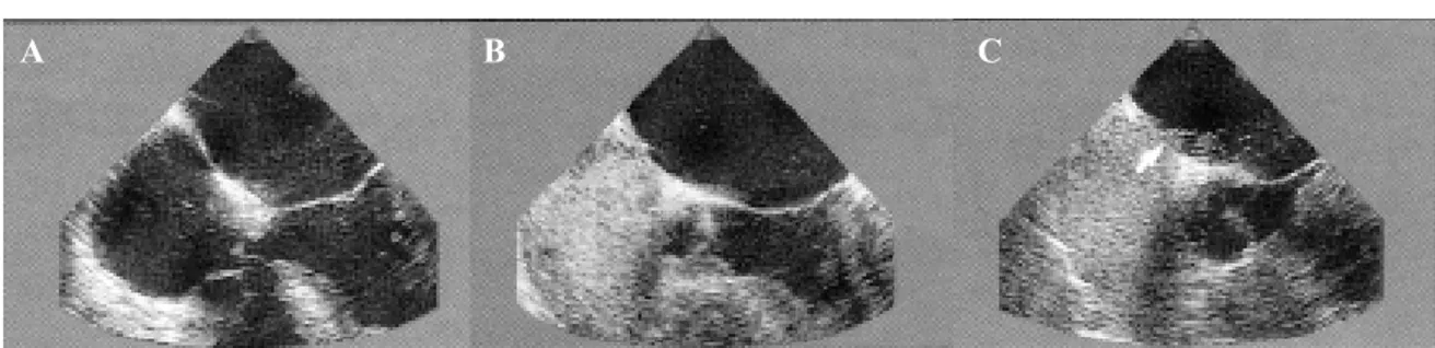 Fig. 1 – Demonstration by transesophageal echocardiography (TEE) of the right-left arterial shunt for patent foramen ovale (PFO) before (A) and after (B, C,) administration of contrast (Echovist) in patient Nº 35 of this series