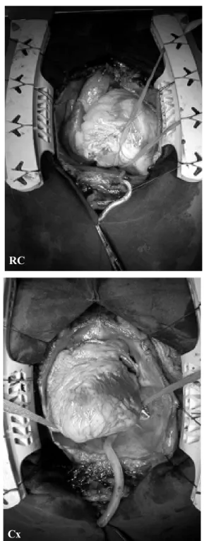 Fig. 3 - Evolution of CABG with CPB and Off-pump CABG over the years (1991 – 2002)