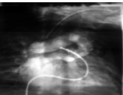 Fig. 2 – Cineangiocardiographic study demonstrating the venous return of the total anomalous pulmonary venous connection of the pulmonary veins in the superior vena cava (supracardiac)