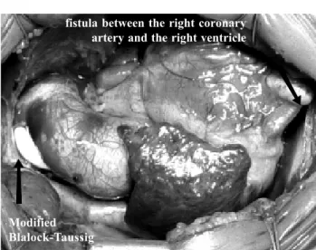 Fig. 1 - Aspect of the heart after the operation demonstrating the position of the modified Blalock-Taussig and the presence of the fistula between the right coronary artery and the right ventricle.