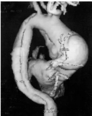 Fig. 2 - Perfusion by the right carotid artery through the PTFE tube connected to the arterial line of the cardiopulmonary bypass.