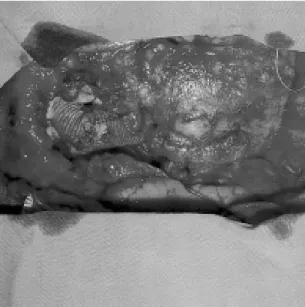 Fig. 4 - Post-operative study by magnetic angioresonance showing the tube substituting the ascending aorta and aortic arch and elephant trunk in the descending aorta.