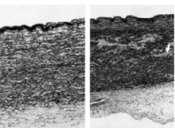 Fig. 2A and 2B - On the left (2A) transversal histological section of the ascending aorta of a 54-year-old male patient with tricuspid aortic valve