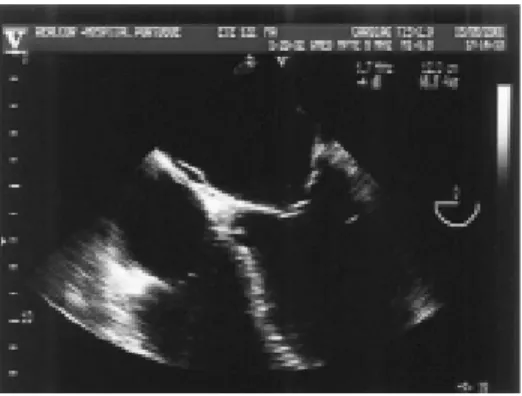 Fig. 3 – Aspect of the transoesophageal echocardiogram, showing rupture of the  non-coronary aortic cuspid