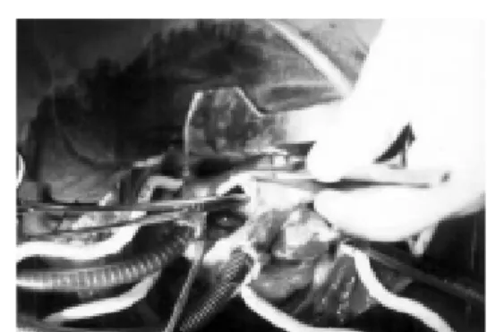 Fig. 6 – Surgical aspect of the rupture of the interatrial septum