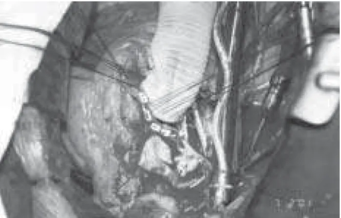 Fig. 2 – Use of bovine pericardium valved prosthesis in Bentall’s surgery.