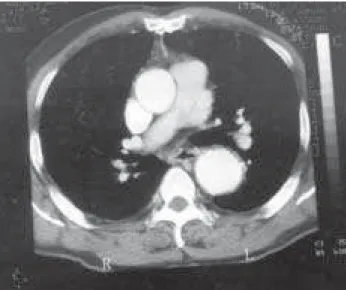 Fig. 7 –  Tomography of patient who evolved with descending aorta dilation 42 months after aortoplasty with patch.