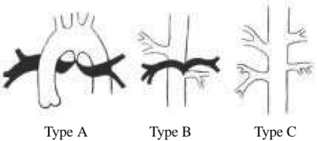 Fig. 1 - Barbero-Marcial classification for the pulmonary vascular blood supply in pulmonary atresia with interventricular communication [5].