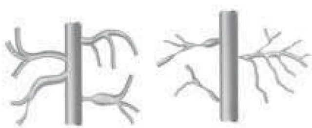 Fig. 4 - Schematic representation of subgroup C1 with thick and medium major aortopulmonary collateral arteries, without predominance of stenosis, supplying all the pulmonary lobes and of subgroup C2 with medium and fine major aortopulmonary collateral art