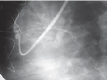 Fig. 4b - late restudy - 62 months after myocardial revascularization (Mg Artery without obstructive lesion)