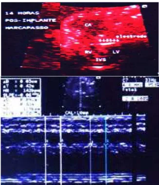 Fig. 2 - Echocardiogram (first postoperative day) revealed recovery of ventricular function, a stable fetal heart rate of 140 bpm and mild pericardial effusion.