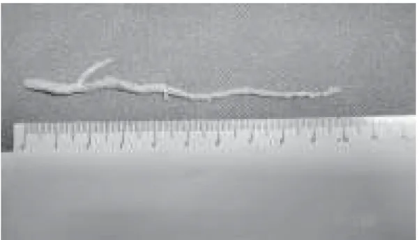 Fig. 3 - Illustrative photograph of the extensive endarterectomy of the anterior interventricular branch performed using the described technique.