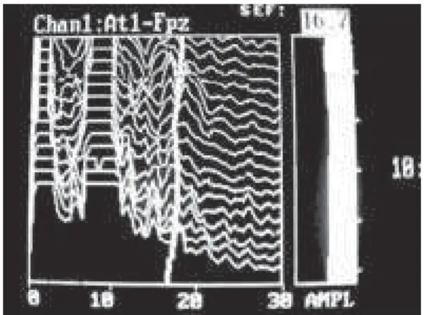 Fig. 3A - 95% SEF (CSA).