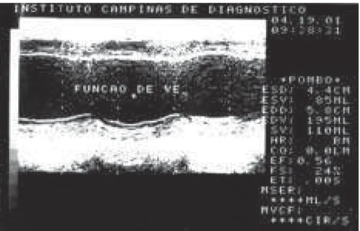Fig. 1 - Mode M of the ventricles, showing LVDD = 58 mm; LVSD
