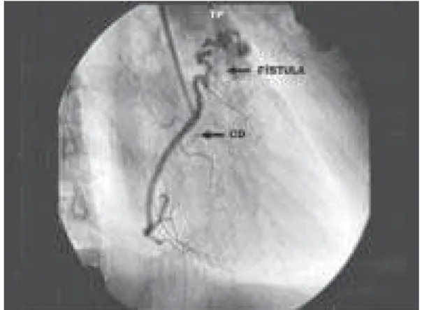 Table 1. Signs and symptoms in patients with isolated coronary artery fistulae