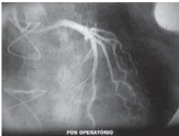 Fig. 2B - Post-operative angiography of the left coronary artery fistula to the pulmonary branch.