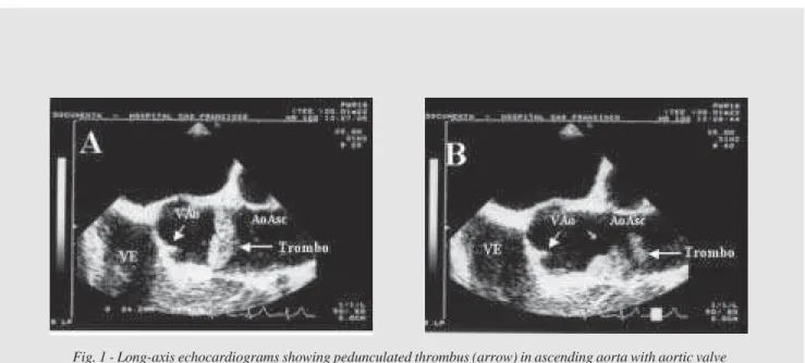 Fig. 1 - Long-axis echocardiograms showing pedunculated thrombus (arrow) in ascending aorta with aortic valve in closed position