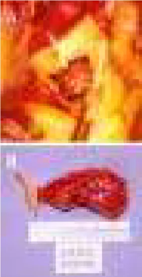 Fig. 2 - A) The thrombus is attached to the posterior aortic wall, B) Macroscopic view of the resected thrombus, showing part of the aortic resected wall (27 x 12 x 10 mm).