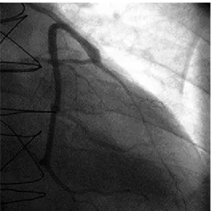 Fig. 3 – Mean proximal diameter of the left internal thoracic artery (LITA) in mm in the groups studied