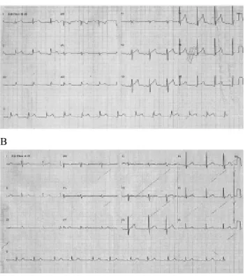 Fig. 1 – A: Electrocardiogram showing horizontal depression of the ST segment in the II, III and aVF (inferior wall) derivations and unspecific alterations of the ST segment in other derivations