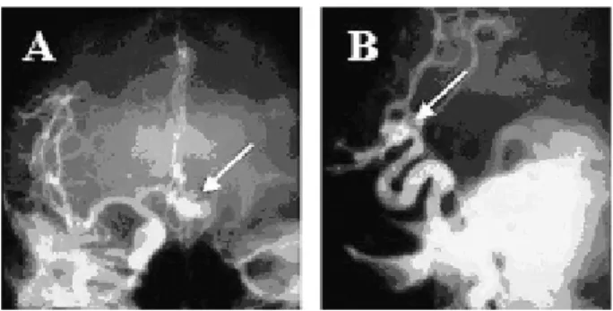 Fig. 1 - Case 1: A - Resected intestinal bowels; B Probable melanosis coli pigmentation