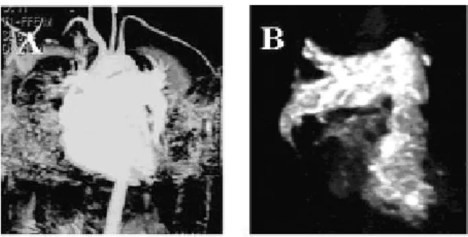 Fig. 3 - Case 3: A and B-Catheter introduced by the femoral vein until the right superior pulmonary vein (PV) contrasting in this phase the left atrium (LA)