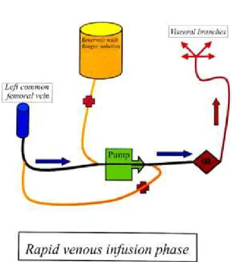 Fig. 2 – In yellow is the cardiotomy reservoir and the connection line containing Lactate Ringer solution