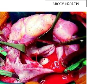 Fig. 1 - Left atrium seen through the opening through the right atrium and interatrial septum