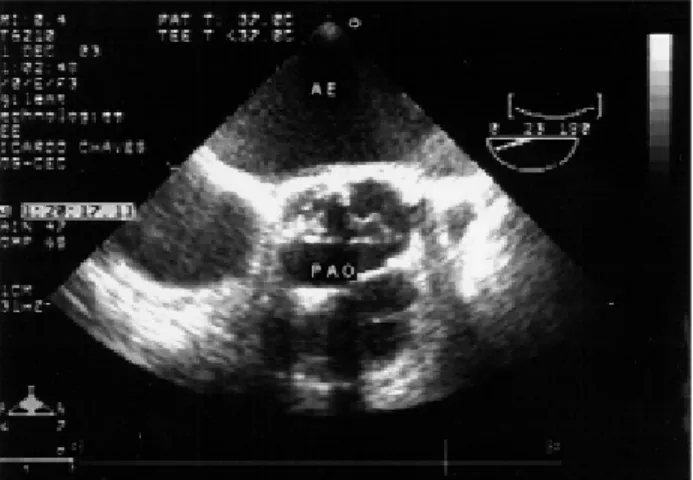 Fig. 6 – Intraoperative transesophageal Doppler echocardiogram of case 2 - The ‘Less Stented’ prosthesis with normal opening and functioning