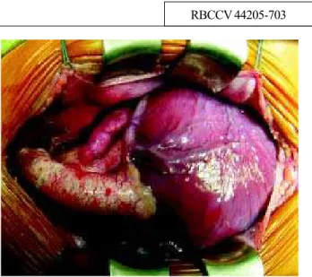 Fig. 1 – Aspecto intra-operatório no qual se observa a aorta anterior com a artéria coronária esquerda principal derivando do seio coronário 1