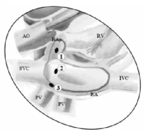 Fig. 1 - Diagram of the foci of ectopic atrial tachycardia in the posterior wall of the right appendages (1), in the upper septal portion (2) and in the free wall of the right atrium (3) [19-21]
